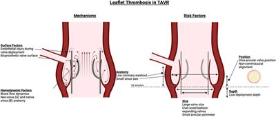 Leaflet thrombosis in transcatheter aortic valve intervention: mechanisms, prevention, and treatment options